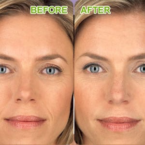 botox before and after woman
