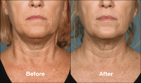 kybella before and after front view
