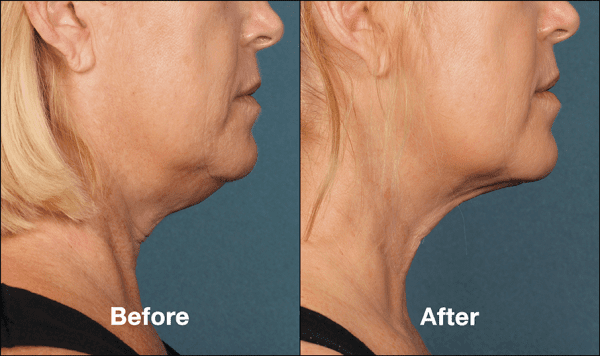 kybella before and after side view