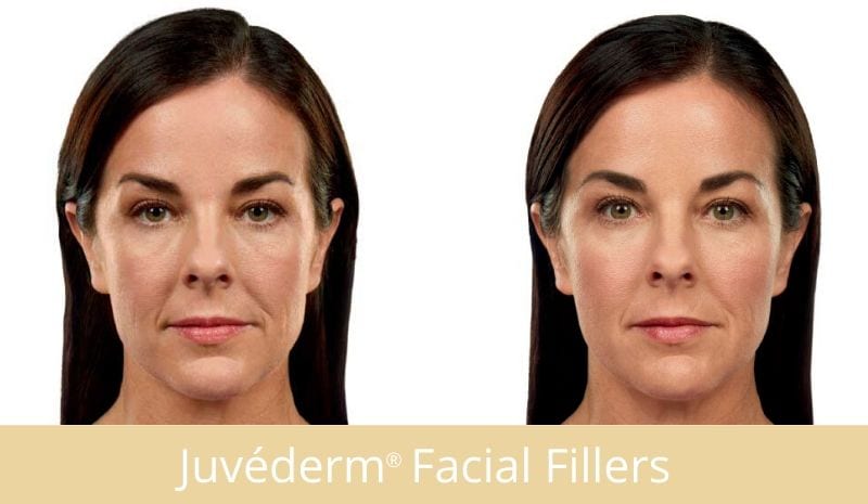  Juvederm® & Juvederm Voluma™ XC
