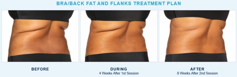 Bra and Back Fat Treatment by Coolsculpting Elite