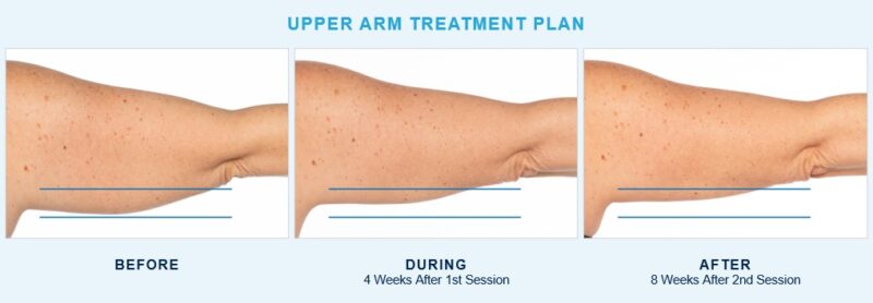 Upper Arm Treatment by Coolsculpting Elte