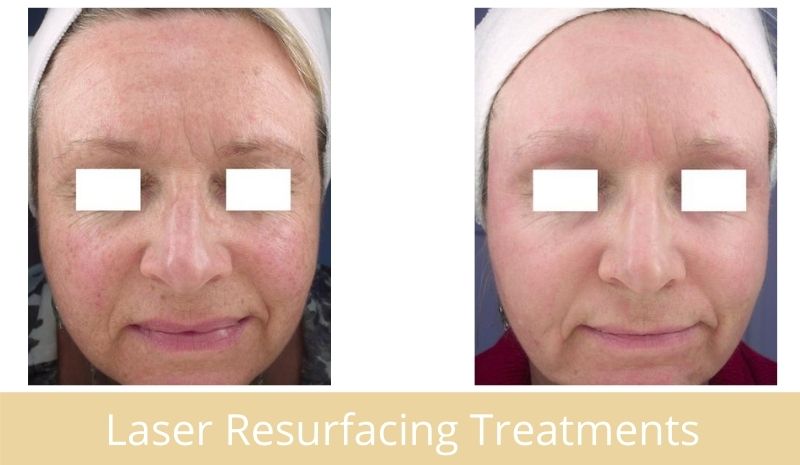 laser resurfacing treatments
